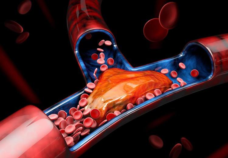 血栓的最新研究
